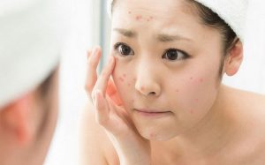 Top 6 Best Home Remedy for Acne: Keep Your Skin Flawless Naturally